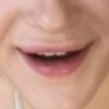 Welche Behandlung für Asymmetrische Mundwinkel?
