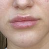 Welche Behandlung für Asymmetrische Mundwinkel?