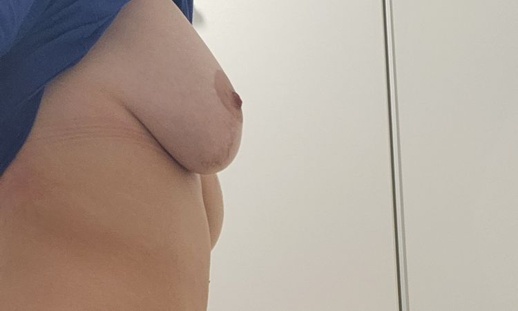 Flache Brust nach Straffung + 290ml Vergrößerung - 68830
