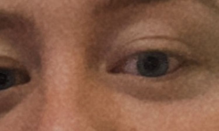 Welche Operation brauche ich für meine Augen? - 68837