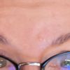 Überschüssige Haut über Augenbrauen. - 69157