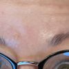 Überschüssige Haut über Augenbrauen. - 69159