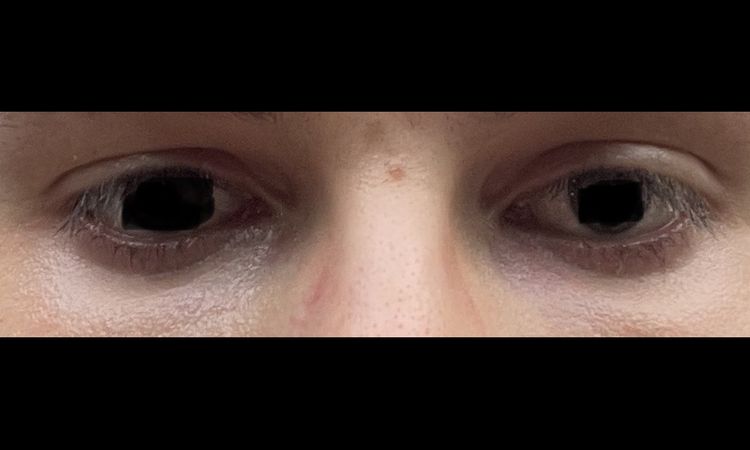 Bei Blepharoplastik zu viel Fett entfernt. - 69251