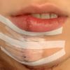 Lippen aufspritzen trotz Narbe durch Lippe ? - 69361