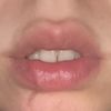 Lippen aufspritzen trotz Narbe durch Lippe ? - 69362