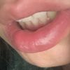 Lippen aufspritzen trotz Narbe durch Lippe ? - 69363