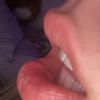Lippen aufspritzen trotz Narbe durch Lippe ? - 69364
