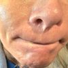 Bullhorn lip lift stark sichtbare Narbe unter der Nase