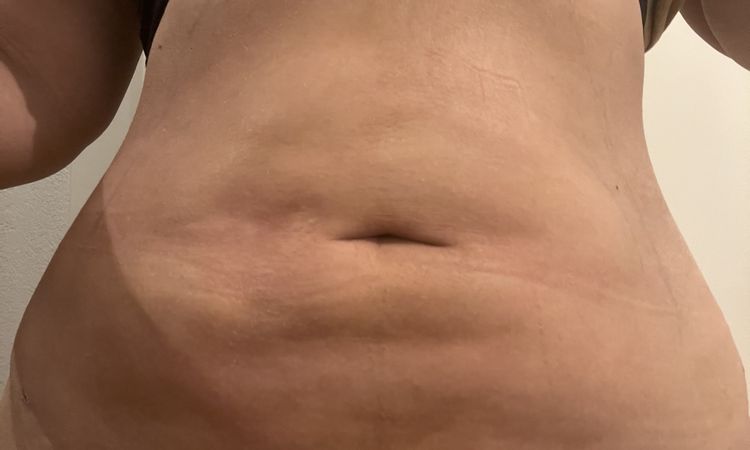 Unebenheiten (Dellen und Verhärtungen) nach Fettabsaugung am Bauch - 69383