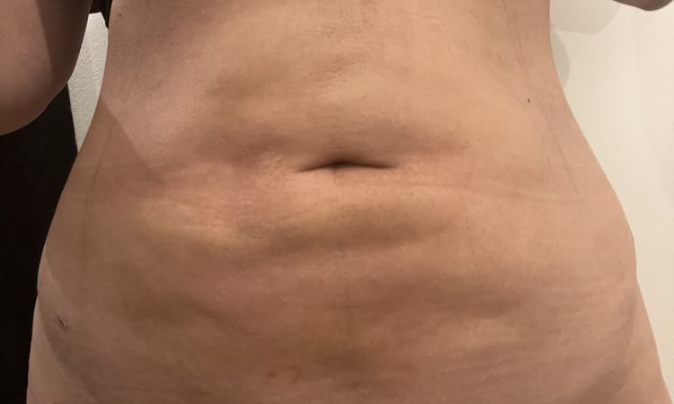 Unebenheiten (Dellen und Verhärtungen) nach Fettabsaugung am Bauch - 69384