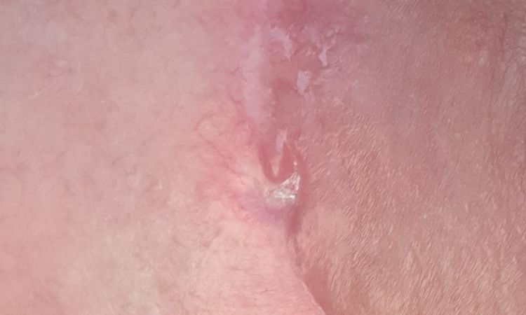 Fäden nach Bruststraffung entzünden sich - 69444