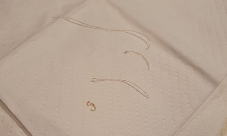 Fäden nach Bruststraffung entzünden sich - 69446