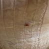 Liposuction an den Beinen nun Gefühlsstörungen