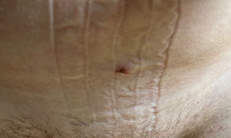 Liposuction an den Beinen nun Gefühlsstörungen - 69547