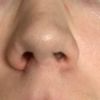 Stabilisierung Nasenflügel/ Hyaluron zur Angleichung?