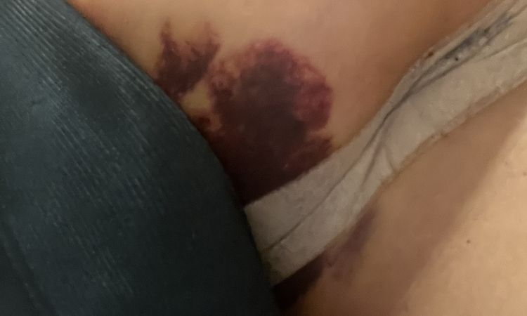 Wann nach Brustvergrößerung duschen und Narbenpflege beginnen? - 69843