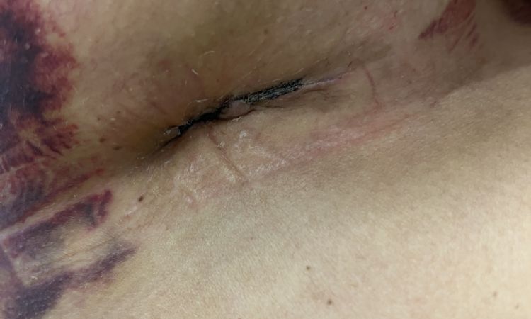 Wann nach Brustvergrößerung duschen und Narbenpflege beginnen? - 69845