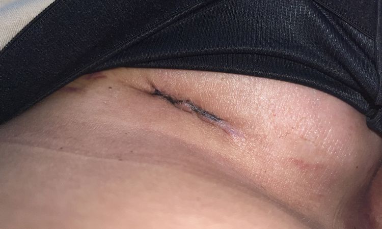Wann nach Brustvergrößerung duschen und Narbenpflege beginnen? - 69847