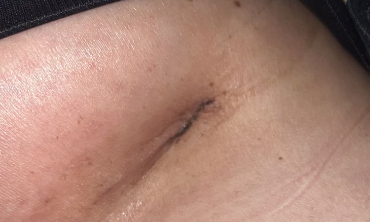 Wann nach Brustvergrößerung duschen und Narbenpflege beginnen? - 69848