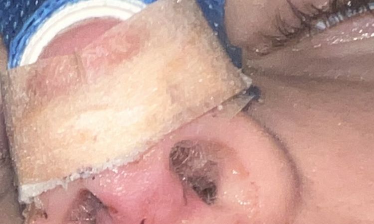 Narbe Nasensteg septum, wulstig nach Nasenkorrektur? Die - 70078