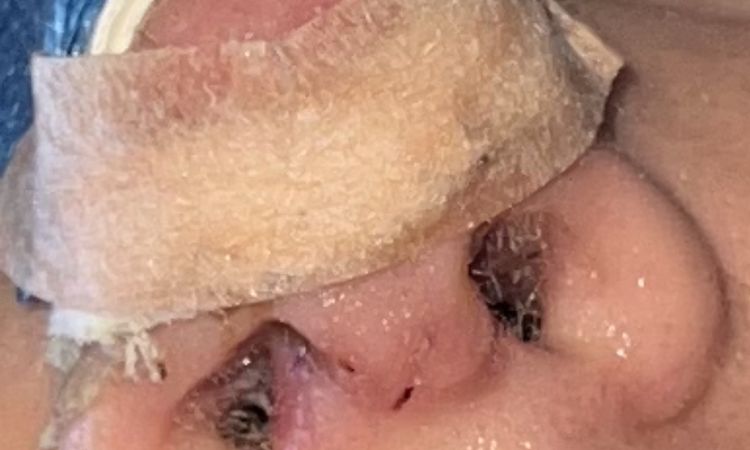 Narbe Nasensteg septum, wulstig nach Nasenkorrektur? Die - 70079