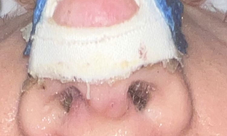 Narbe Nasensteg septum, wulstig nach Nasenkorrektur? Die - 70080