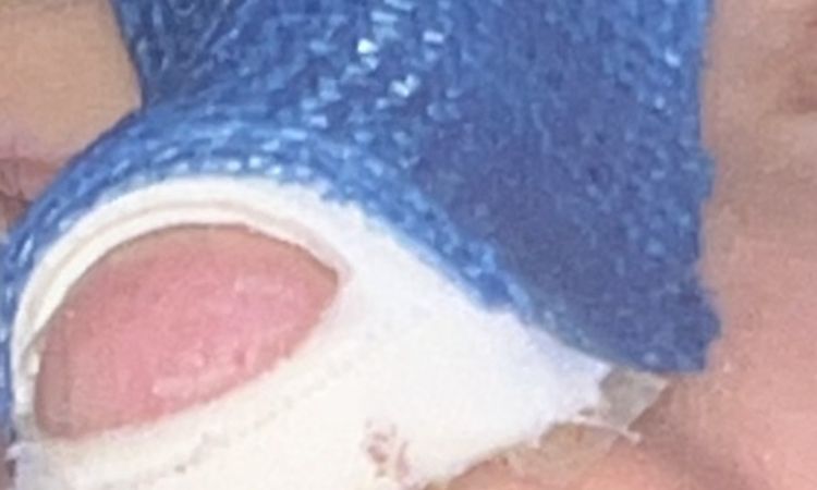 Narbe Nasensteg septum, wulstig nach Nasenkorrektur? Die - 70082