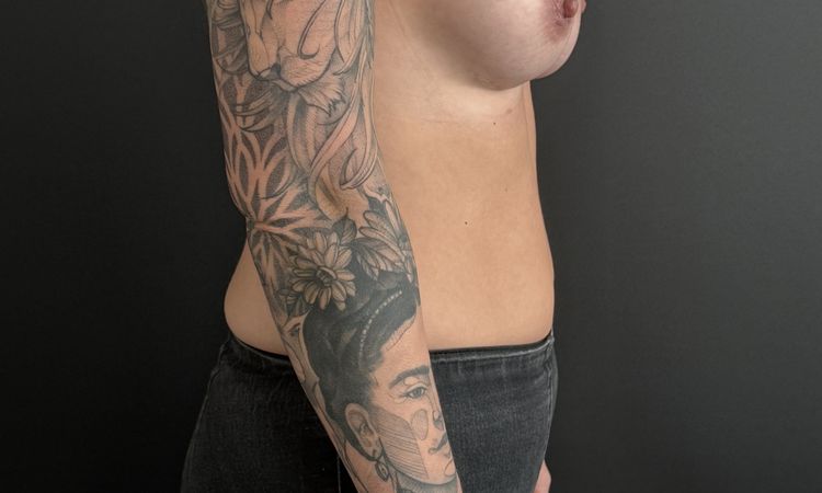 Implantatwechsel - Straffung wirklich nötig? - 70135