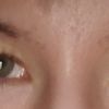 Asymmetrische Augen korrigieren - 70176