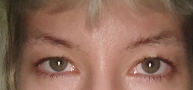 Asymmetrische Augen Korrigieren Estheticon De