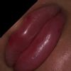 Lippe zuckt nach Hyaluron Behandlung