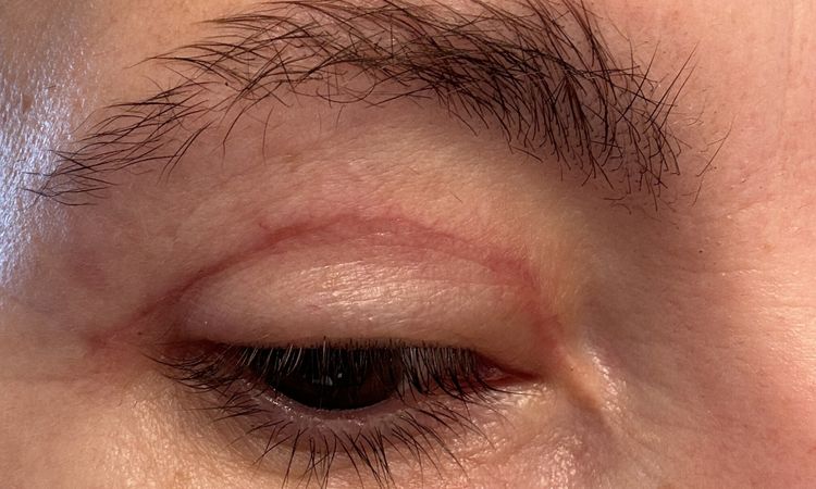 Auge verengt nach Oberlidstraffung - 70387