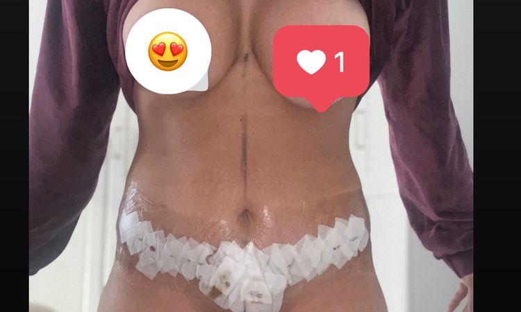 Bauchdeckenstraffung was kann man gegen die Schwellung tun am Bauch? - 70416