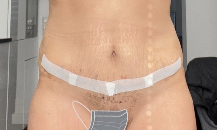 Bauchdeckenstraffung was kann man gegen die Schwellung tun am Bauch? - 70419
