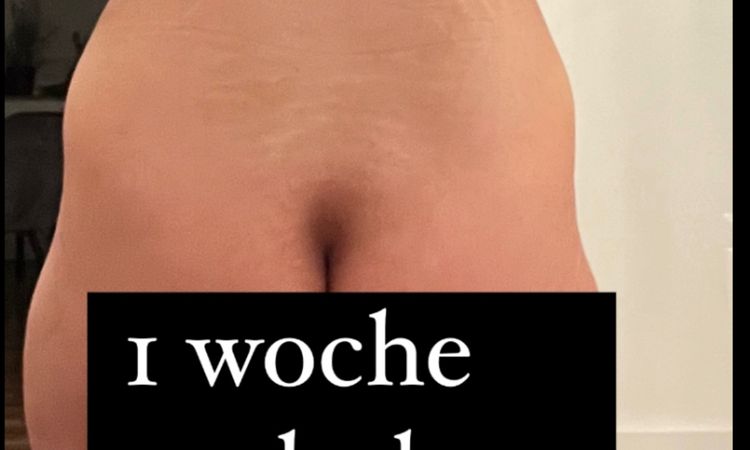 Bauchdeckenstraffung was kann man gegen die Schwellung tun am Bauch? - 70420