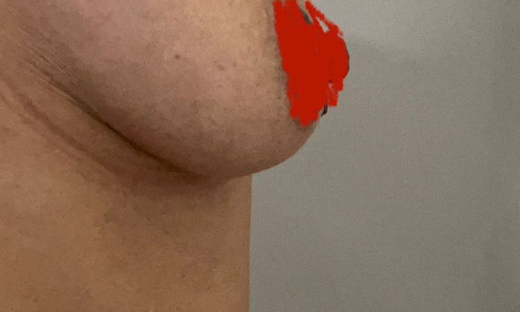 Welche Implantate für Hängebrüste ersten Grades? - 70751