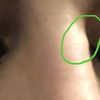 Kleiner seitlicher ‚Höcker’ an Nase - Korrektur ohne OP?