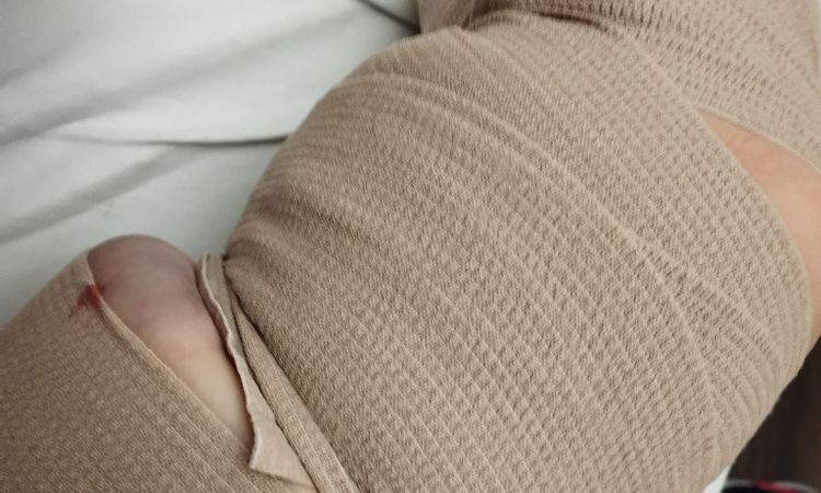 Verschlechterung 4 Wochen nach Liposuktion - 70807
