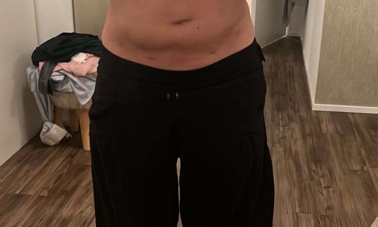 Oedem nach Liposuction - 70832