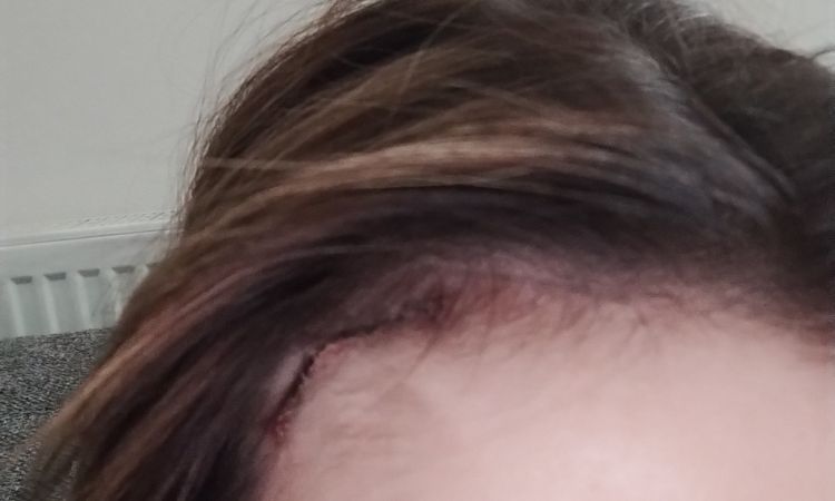 Asymmetrie der Augen nach Browlift mit Unterlidstraffung - 70846