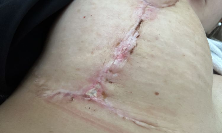 Stellen entzündet nach Bruststraffung mit Implantatwechsel - 70893