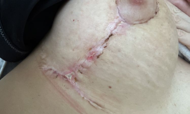 Stellen entzündet nach Bruststraffung mit Implantatwechsel - 70894