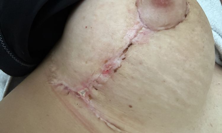 Stellen entzündet nach Bruststraffung mit Implantatwechsel - 70895