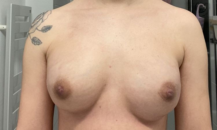 Asymmetrie nach Implantattausch verstärkt sich - Implantat rutscht hoch? - 71038
