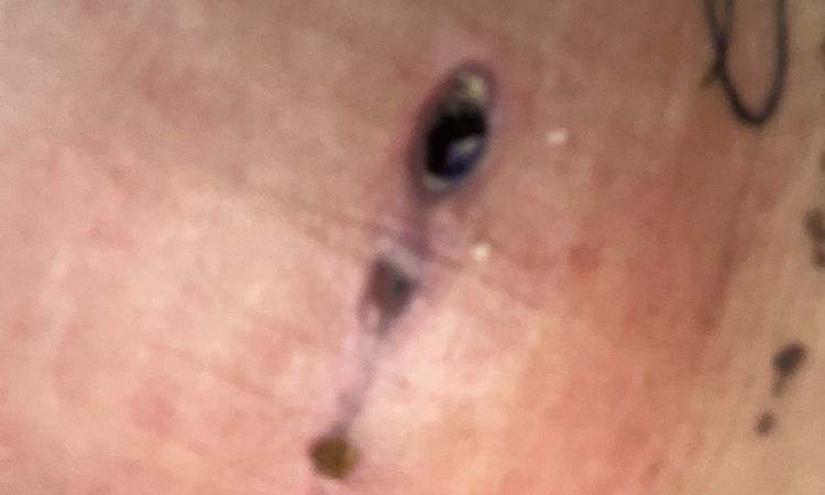 Implantat nach Brust Op sichtbar . - 71046