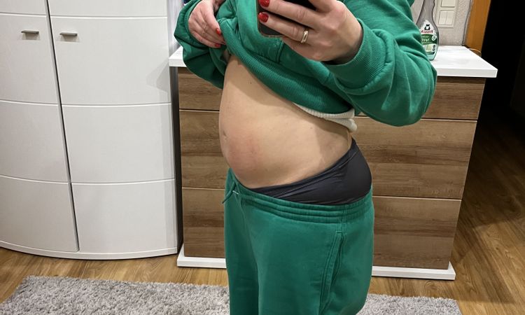 Zweite Bauchdeckenstraffung möglich? - 71104