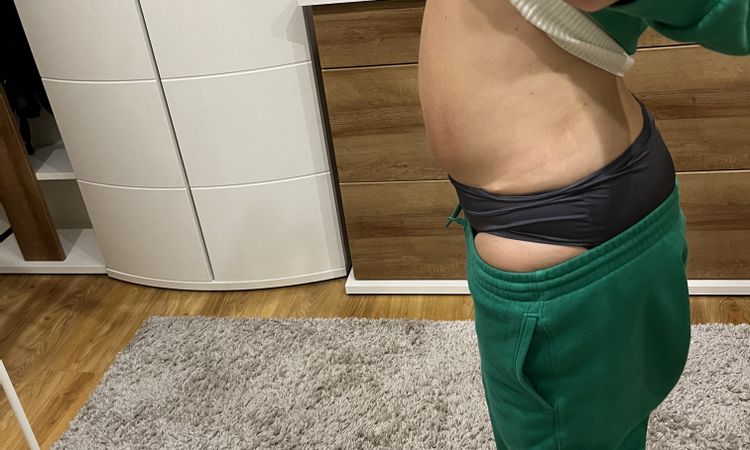 Zweite Bauchdeckenstraffung möglich? - 71105