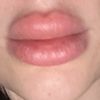 Lippen nach hylase noch voller - 71191