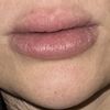 Lippen nach hylase noch voller - 71192