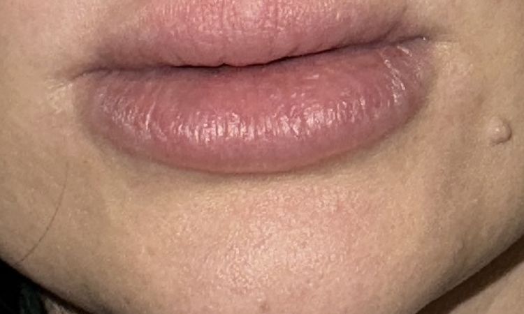 Lippen nach hylase noch voller - 71192